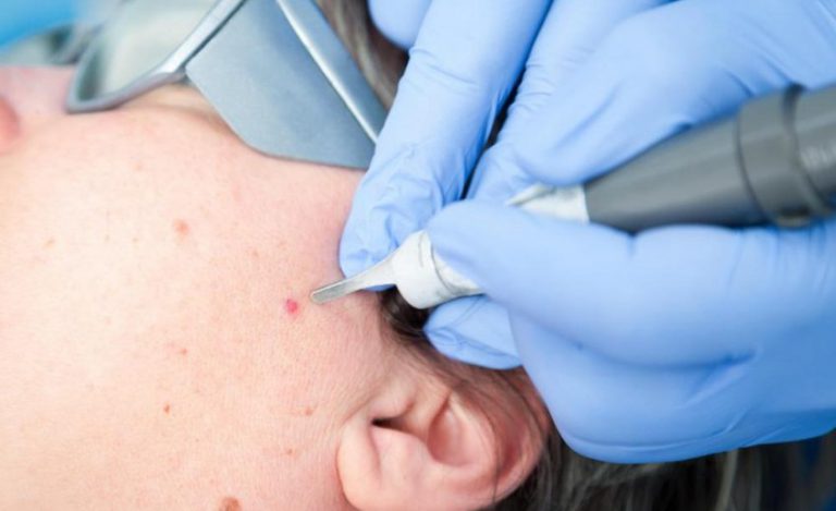 Latest technology skin treatment