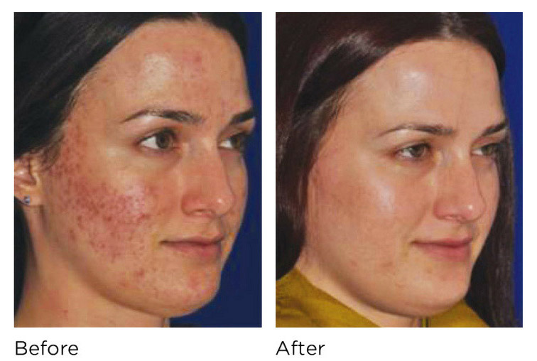 Before and after of skin treated at darpan skin and hair clinic