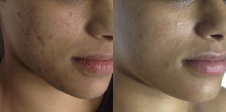 Before and after of skin treated at darpan skin and hair clinic