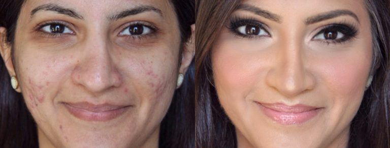 Before and after of skin treated at darpan skin and hair clinic