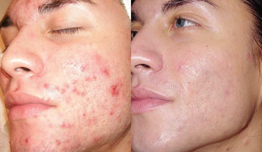 Before and after of skin treated at darpan skin and hair clinic