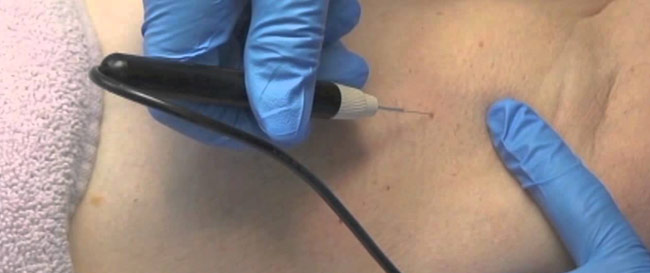 Latest technology skin treatment