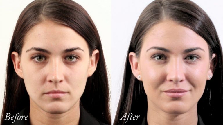Before and after of skin treated at darpan skin and hair clinic