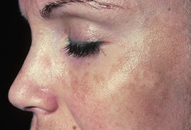 skin pigmentation