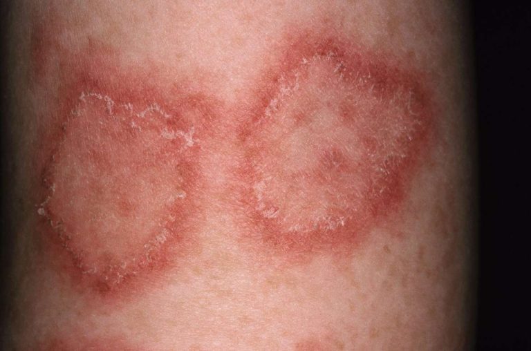 skin issues